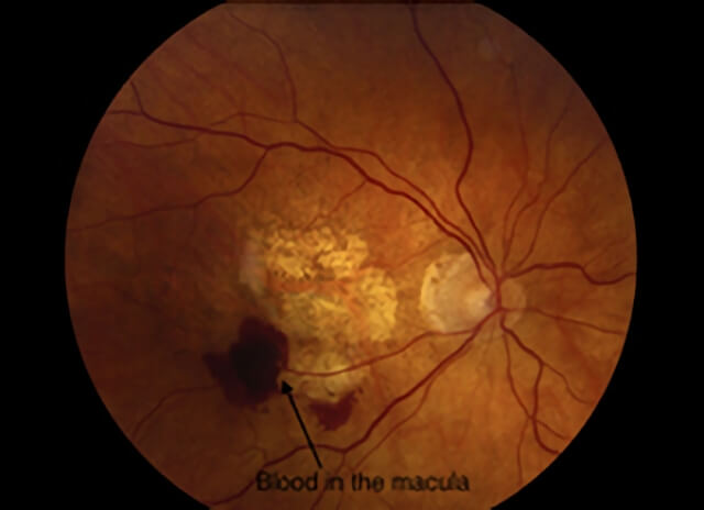 Wet Macular Degeneration 03