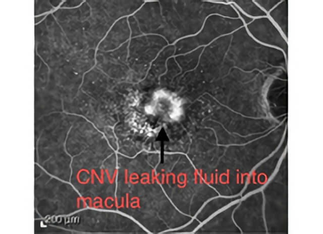 Wet Macular Degeneration 02