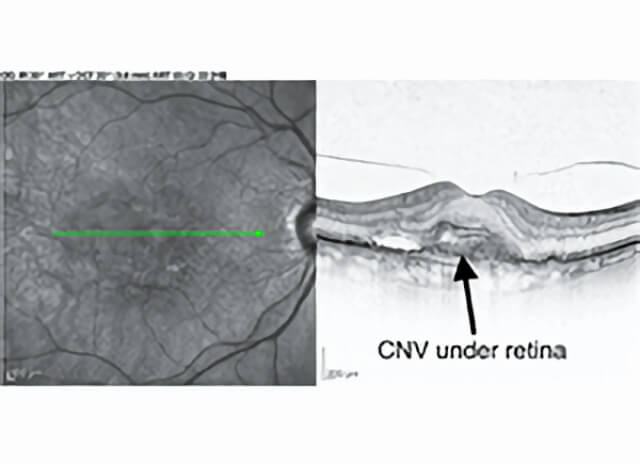 Wet Macular Degeneration 01