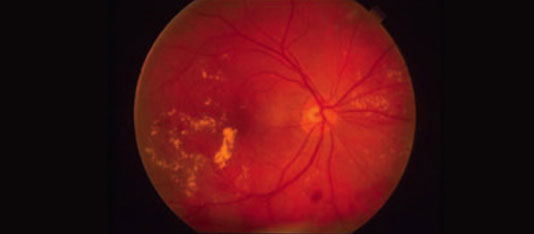 Hero focal laser treatment