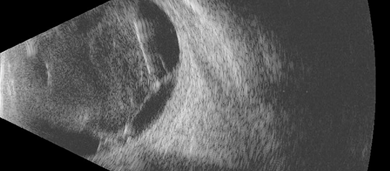 Ophthalmic Ultrasound