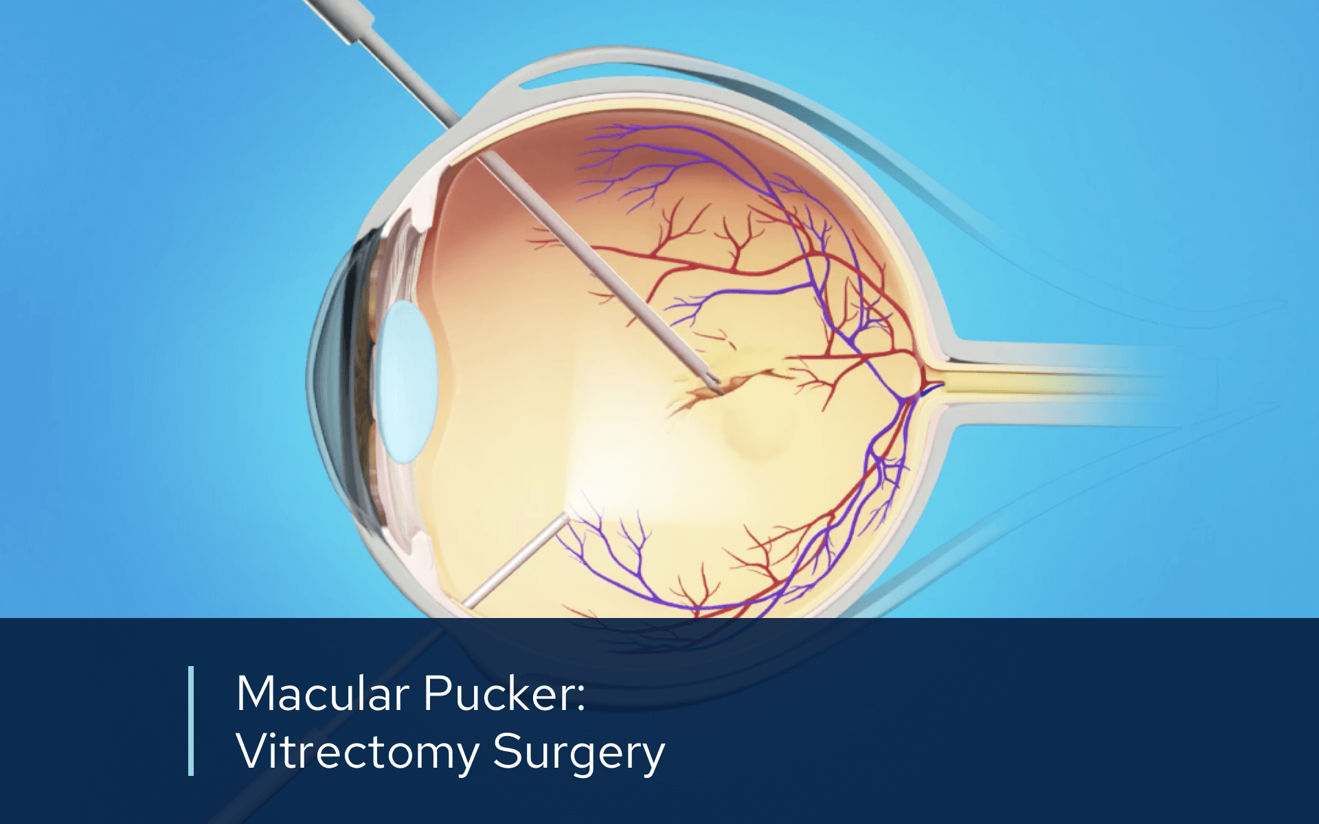 Video macular pucker vitrectomy