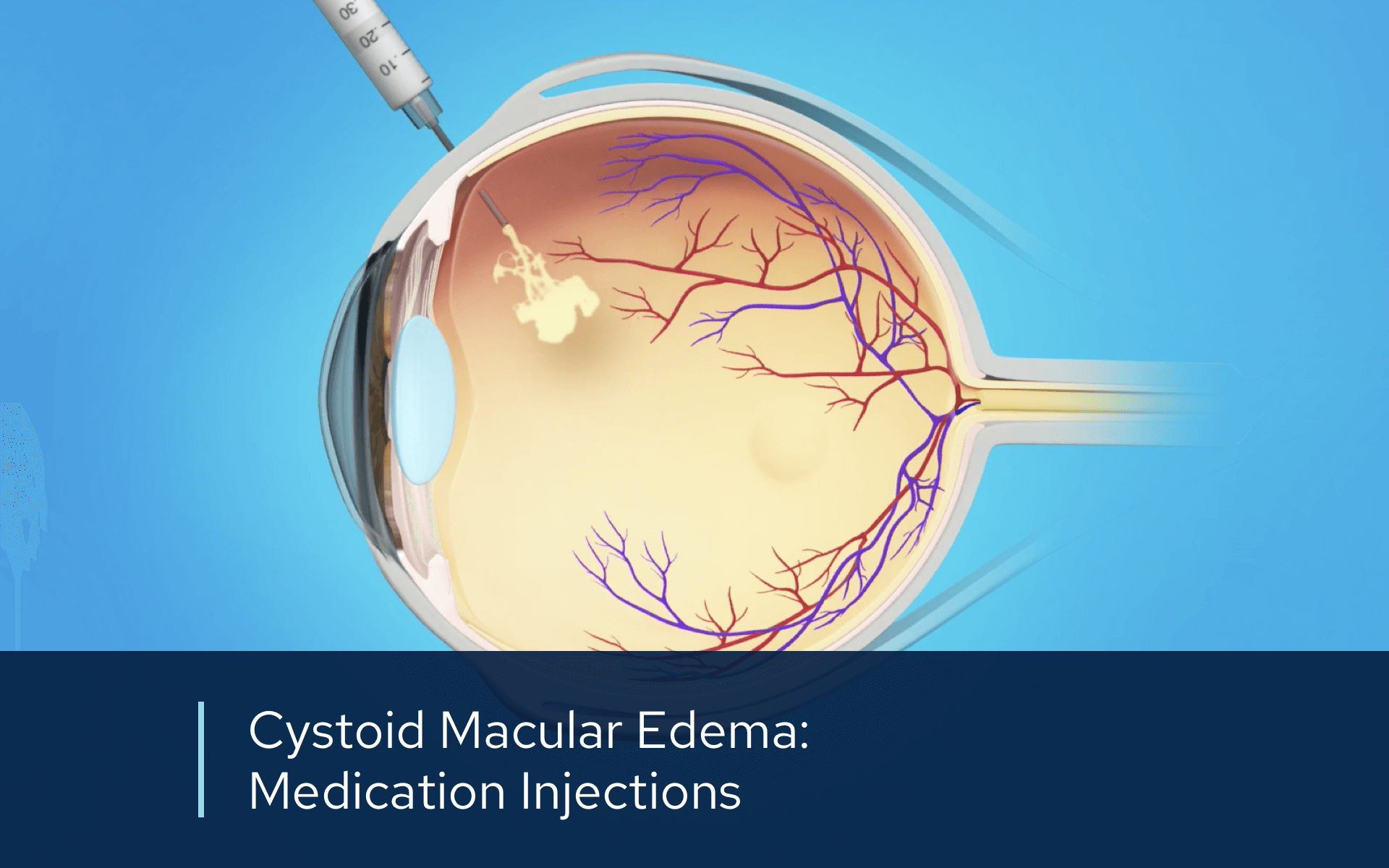 Video retina cme injections