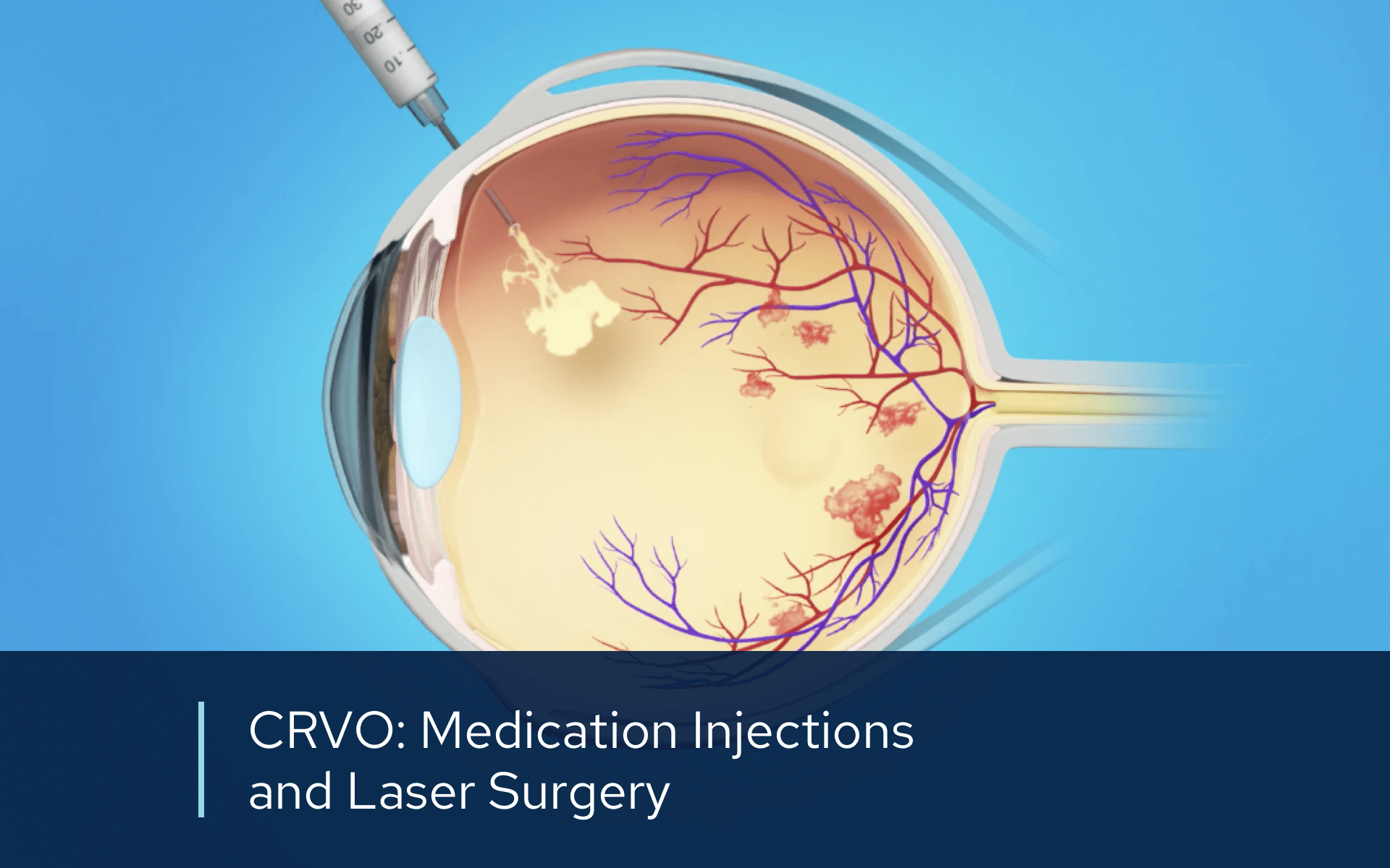 Video retina CRVO Inections Laser
