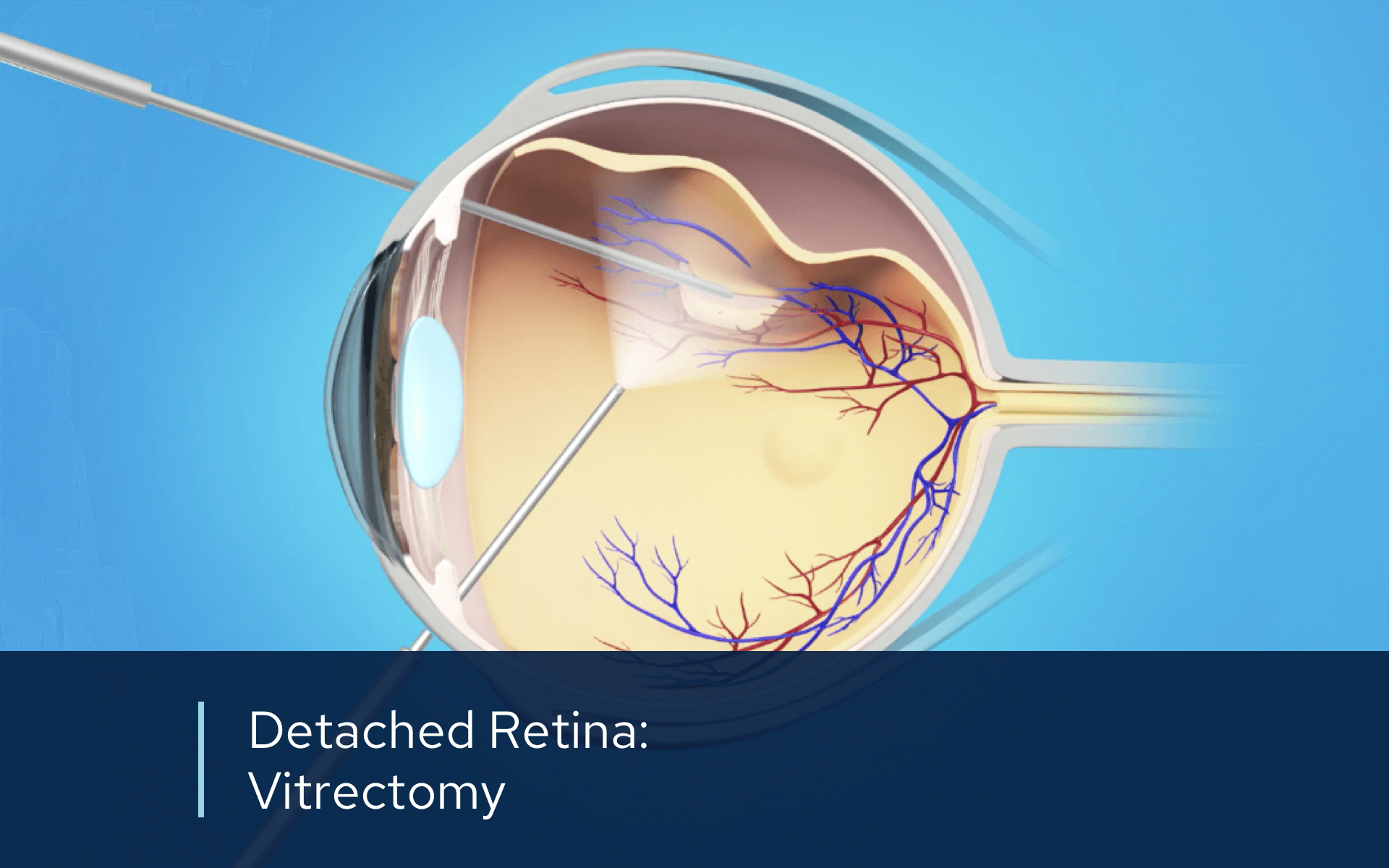 Video retina detached vitrectomy