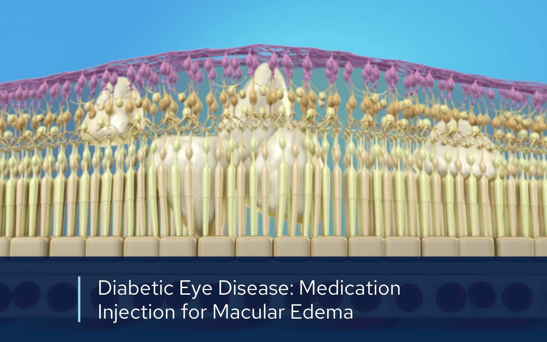 Video retina diabetic injection macular edema
