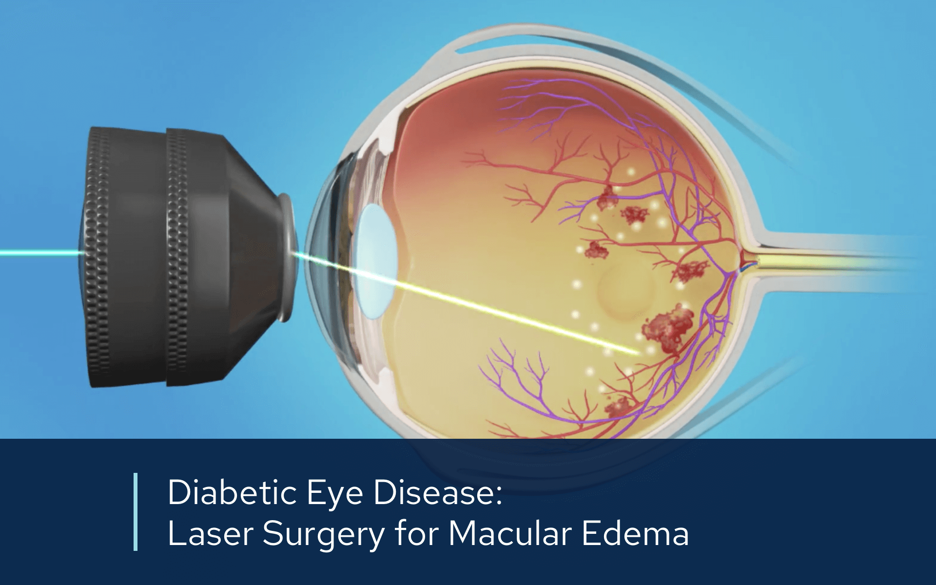 Video retina diabetic laser macular edema