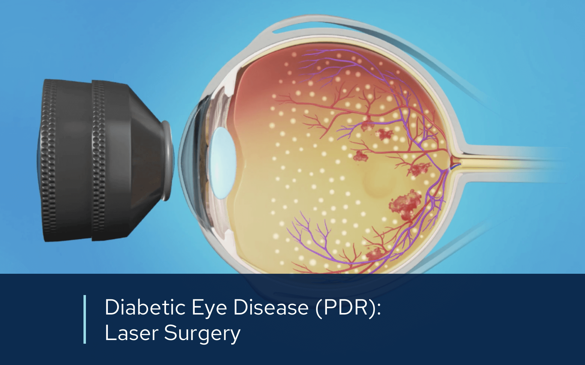 Video retina diabetic pdr laser
