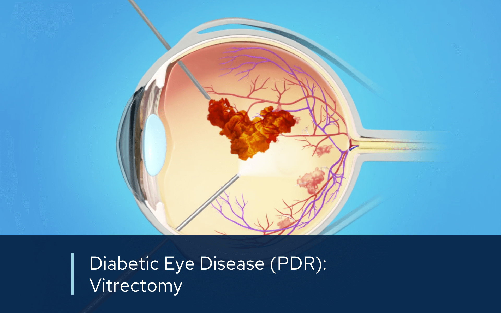 Video retina diabetic pdr vitrectomy