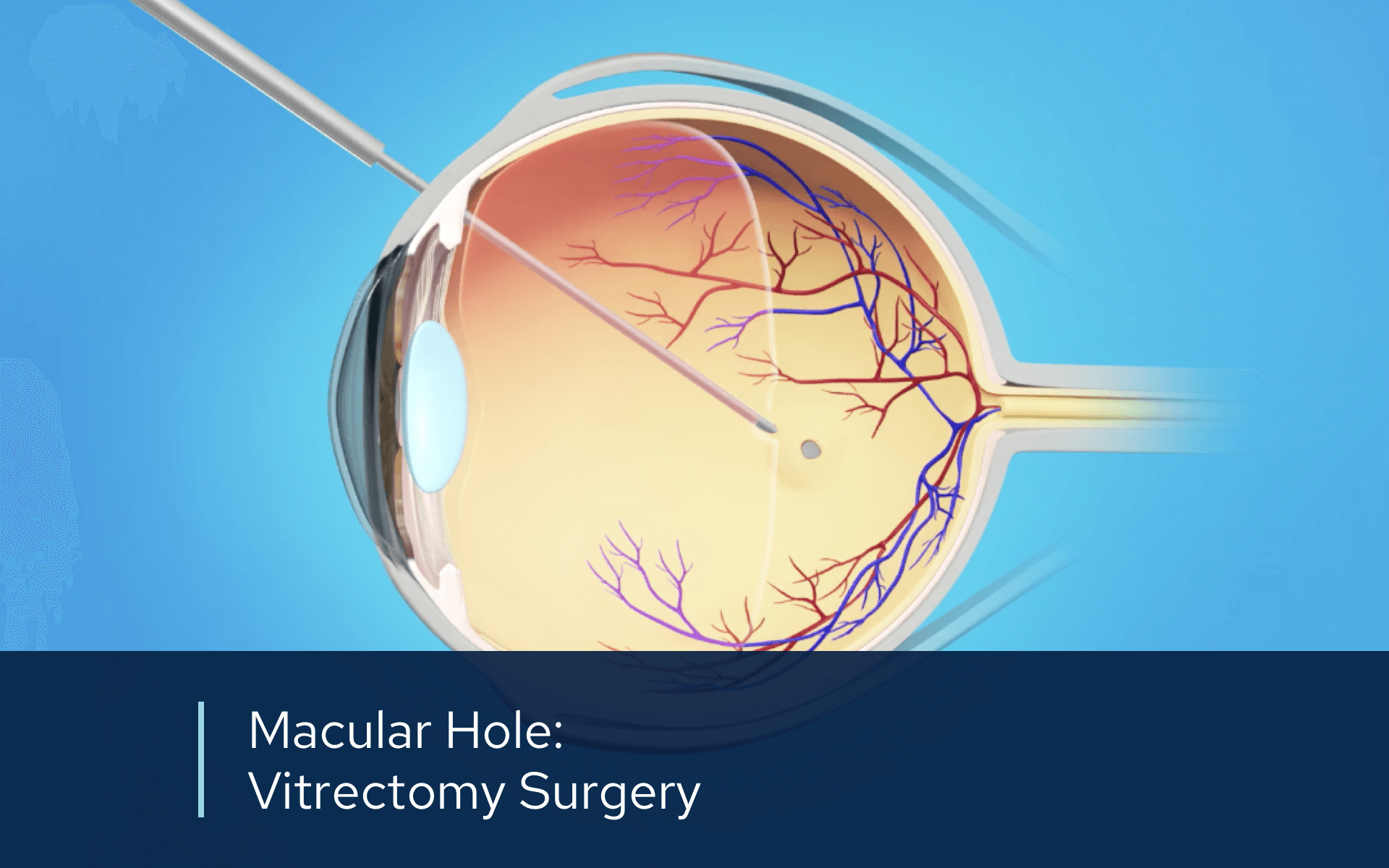 Video retina macular hole surgery