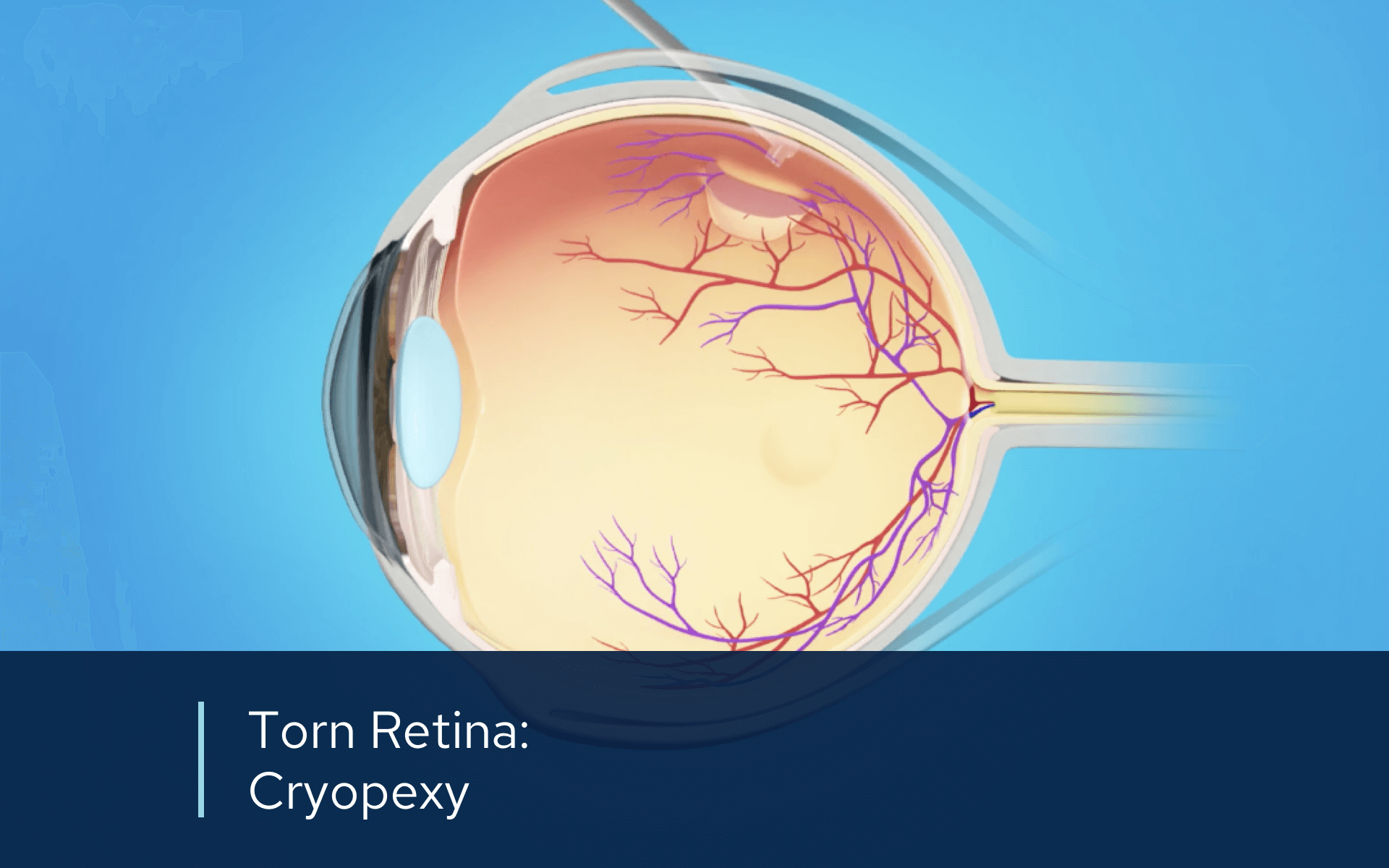 Video retina torn cryopexy