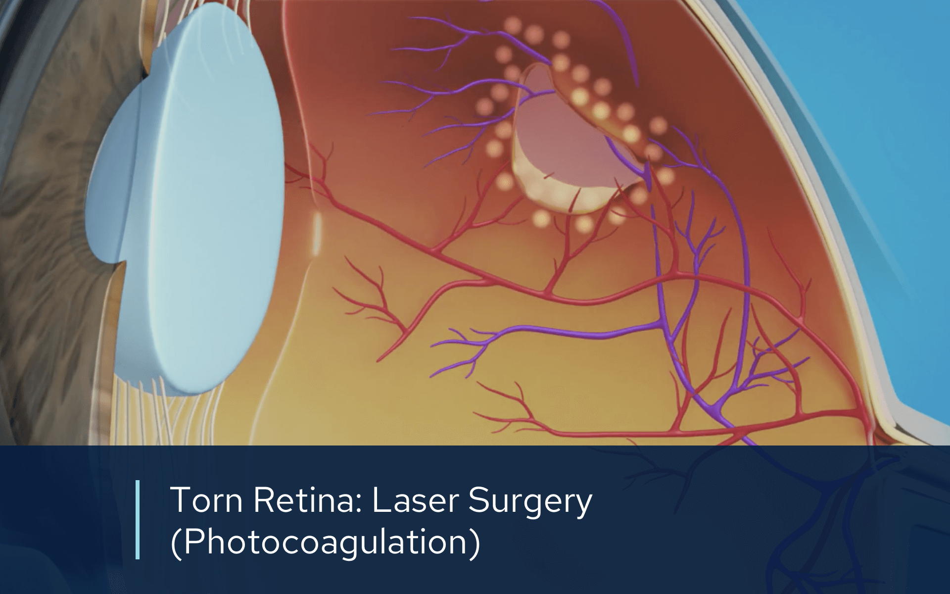 Video retina torn photocoagulation