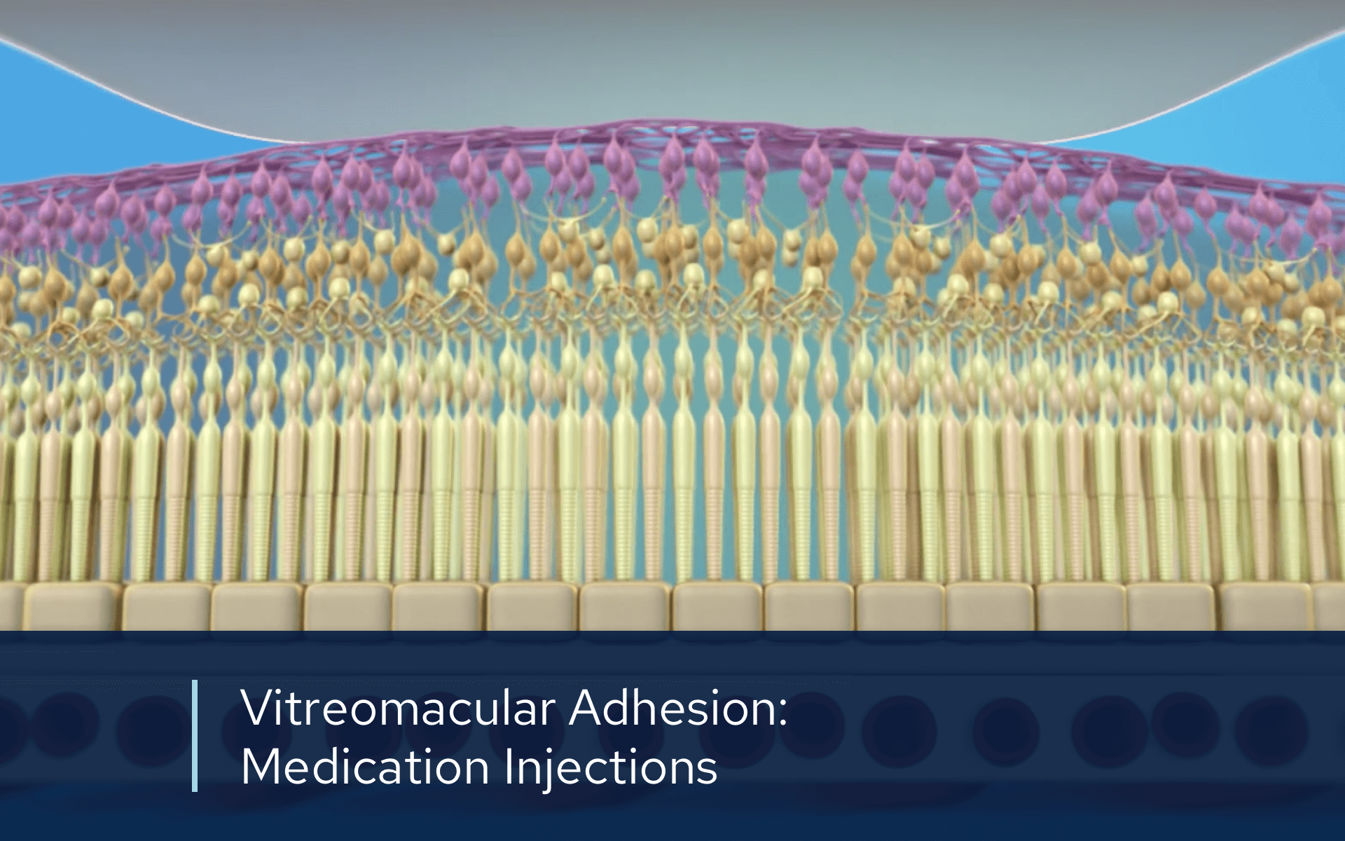 Video retina VMA inections