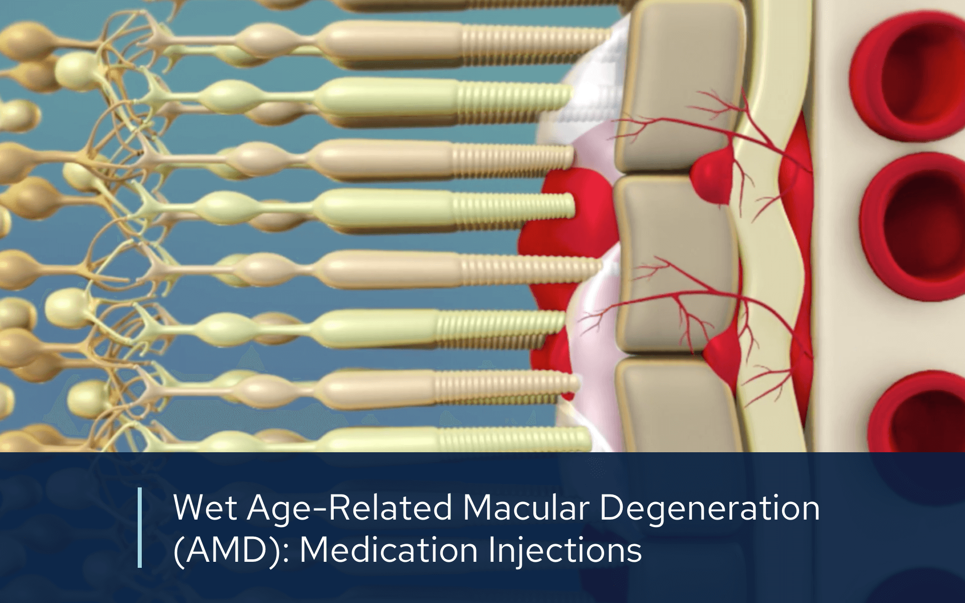 Video retina wet amd medication inection